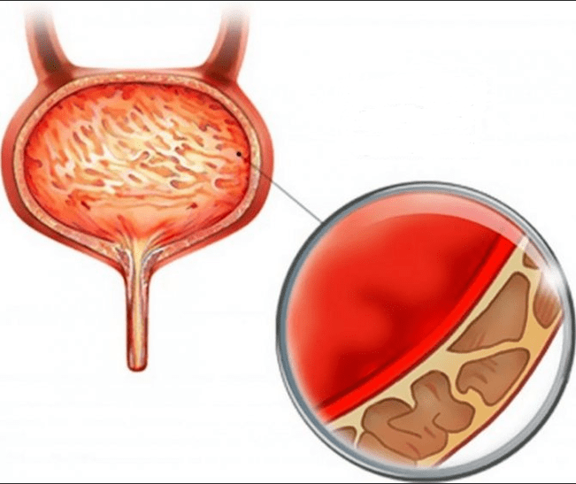 Inflamarea cistitei